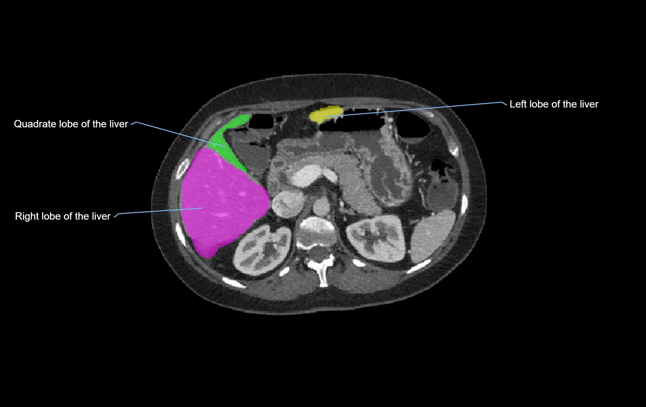 CT lliver lobes axial cross sectional anatomy labelled image -00037.webp